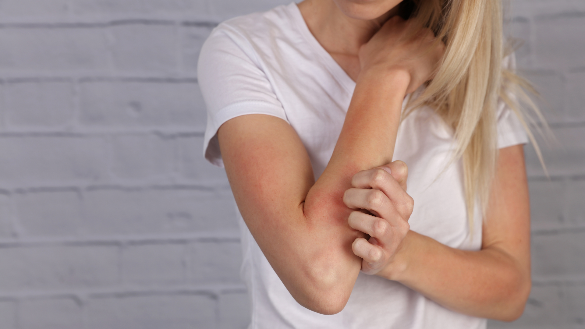 Eczema and Gut-Health: a Relationship That’s More than Skin Deep￼